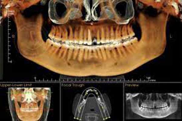 سی تی اسکن فک و صورت CBCT