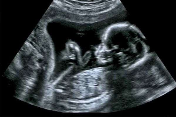  توضیح فرا صوت یا UltraSound 